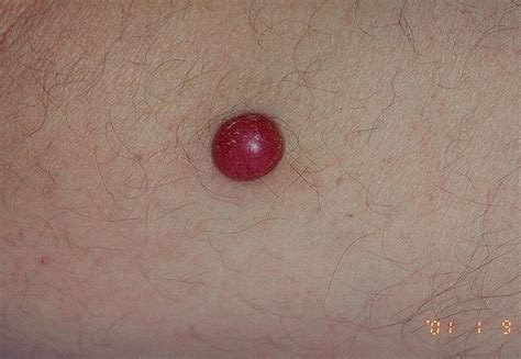 red nodular melanoma pictures